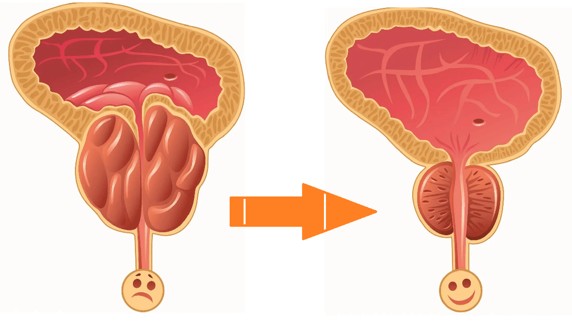 Efecto de Uromexil Forte na próstata en prostatite e adenoma